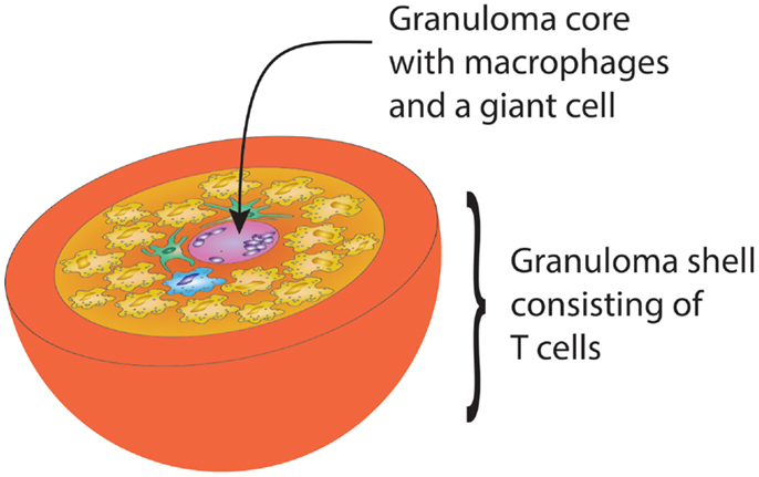 What causes formation of granuloma?