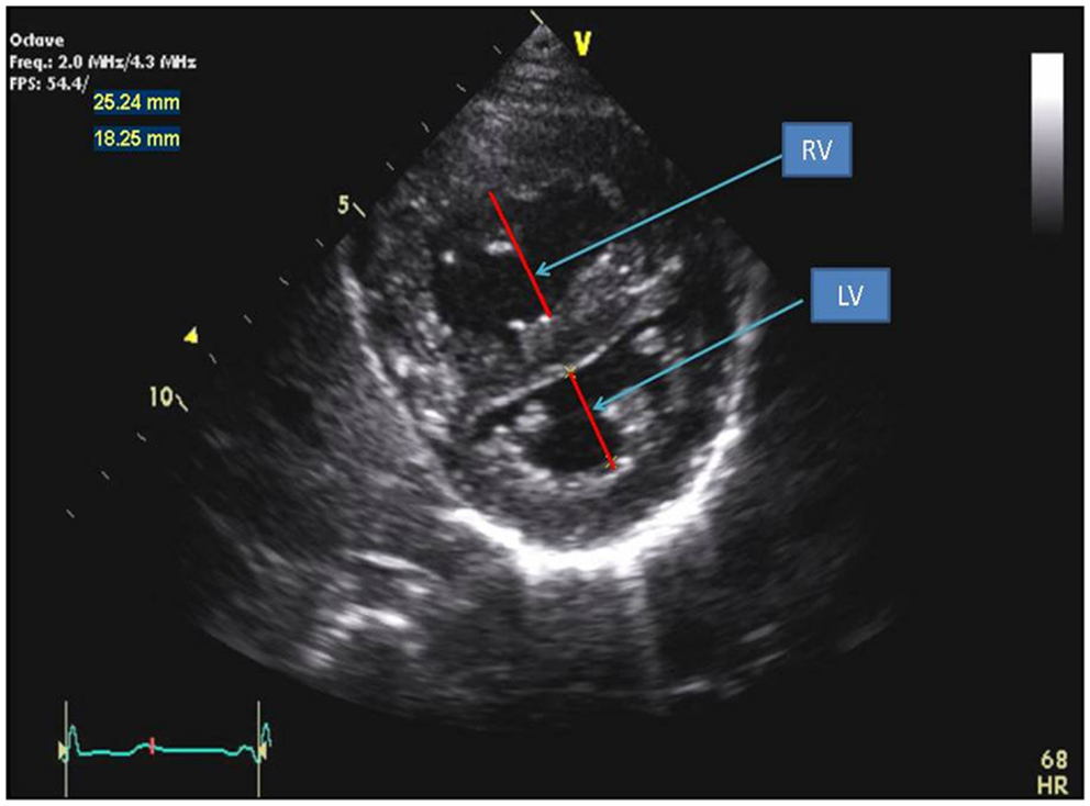 Frontiers | Echocardiography in Pediatric Pulmonary Hypertension | Pediatrics