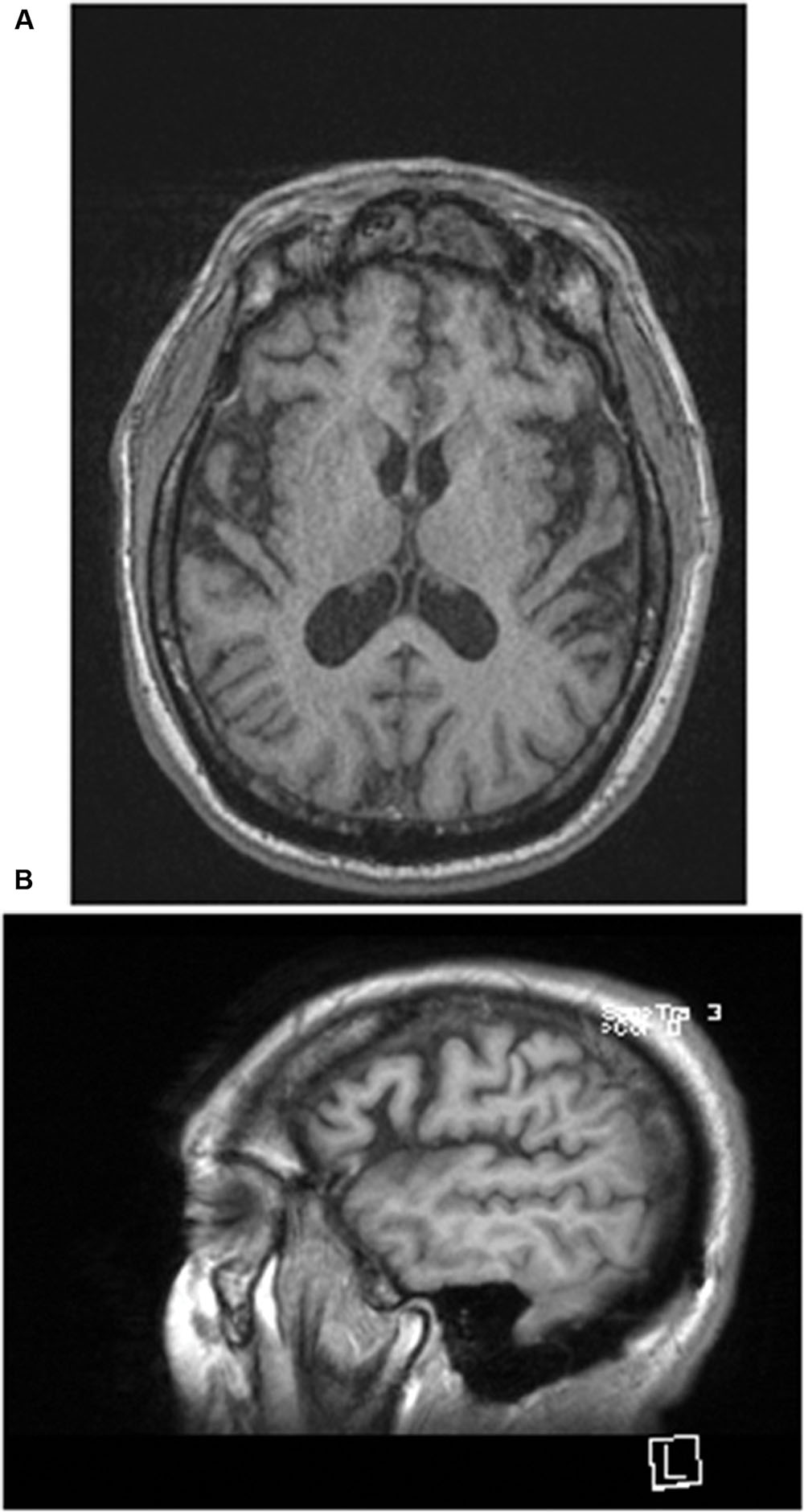 Phantoms in the Brain Essay