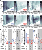 electrophysiological sequelae of hemispherotomy in ipsilateral