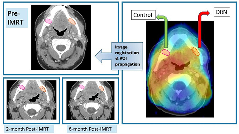 CT scans showing development of ORN