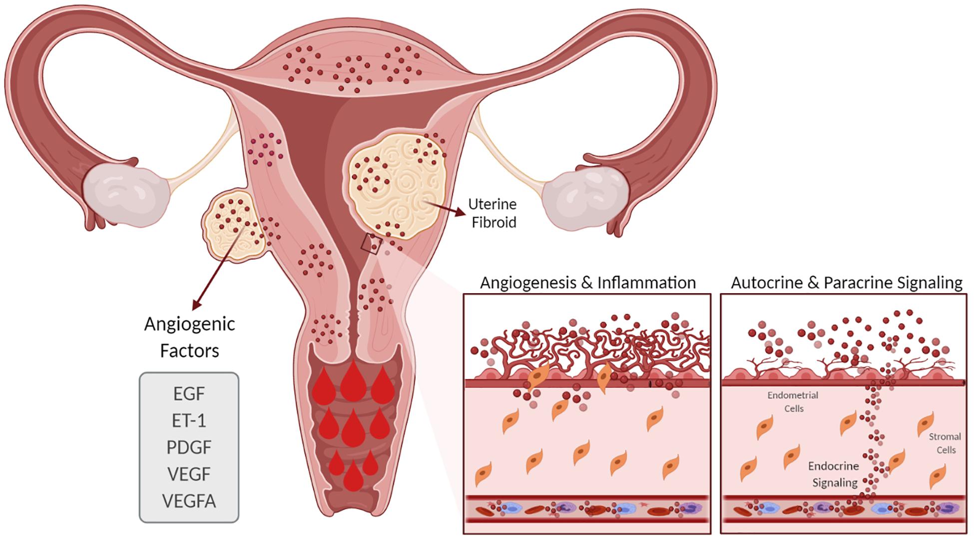 Frontiers Understanding The Impact Of Uterine Fibroids On Human