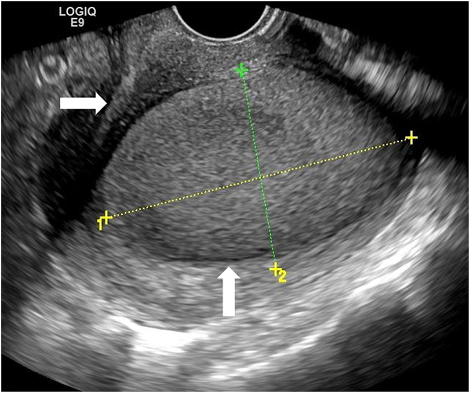 Frontiers Ultrasound Guided Transvaginal Aspiration And Sclerotherapy