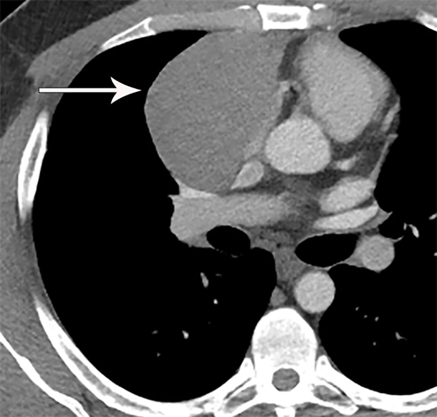 Frontiers Imaging Evaluation Of Thymoma And Thymic Carcinoma