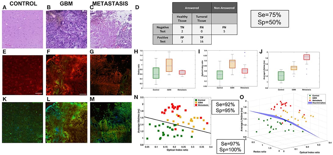 Analysis of NIR data. Comparison of three tissue groups: control (A,E,K), glioblastoma (B,F,L) and metastasis (C,G,M) with different imaging techniques H&E (A,B,C), TPEF imaging (A,F,G) and FLIM (K,L,M). Results of the “blind” analysis on TPEF for diagnosis (D). Boxplot of the spectral molecular analysis, redox ratio (H) and optical index (I), these results were combined in a scatter plot (N). Boxplot of the average lifetime (J). 3D-scatter of the two molecular indicators and the average lifetime to build a discriminative algorithm (O).