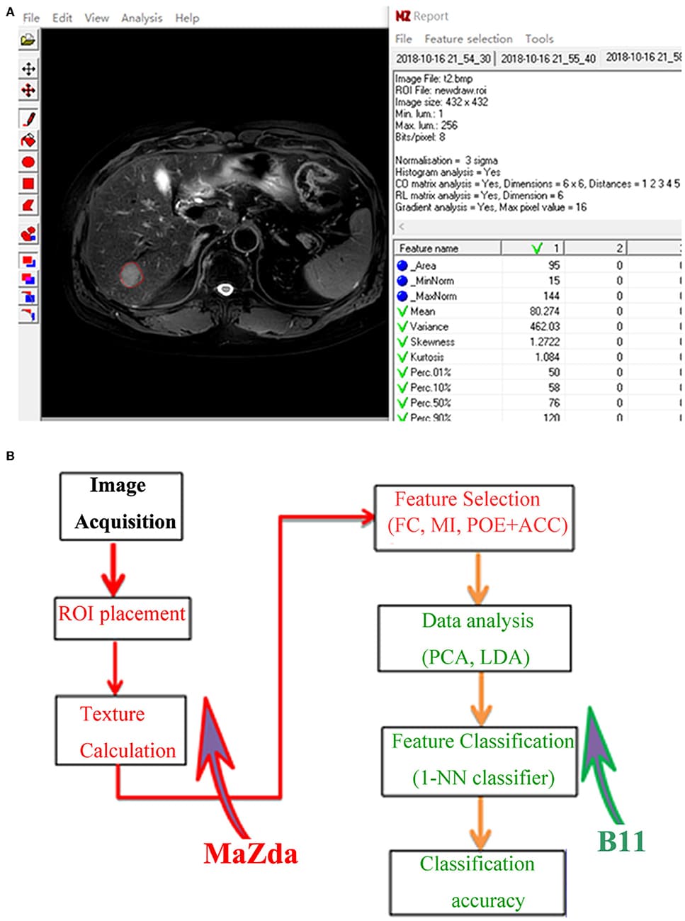 (A) Texture calculation for a 63-year-old man with a pathologically proven hepatocellular carcinoma (HCC) on fat-saturated T2-weighted images by using MaZda. A single region of interest (ROI) was defined and delineated on the image section depicting the maximum lesion diameter. (B) Procedure of texture analysis: texture calculation and feature selection were performed using MaZda; data analysis and classification were performed using program B11. ROI, region of interest; FC, Fisher coefficients; MI, mutual information; POE + ACC, minimization of both classification error probability and average correlation coefficients; PCA, principal component analysis; LDA, linear discriminant analysis; 1-NN, first nearest neighbor.