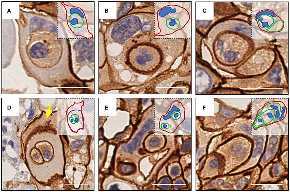 Complex morphologies of CIC structures. (A) One cell was internalized. (B) abnormal nucleus of the outer cell. (C) Two cells were internalized, and the nucleus of one of them was missing. (D) The cell enclosing two cells was inside of another cell (yellow arrow) without nucleus. (E) Two cells were internalized, and the nucleus of the outer cell was deformed. (F) Sequential internalization of three cells. Inserted pictures are schematic cartoons for the indicated CIC structures, respectively. Scale bar: 20 μm.
