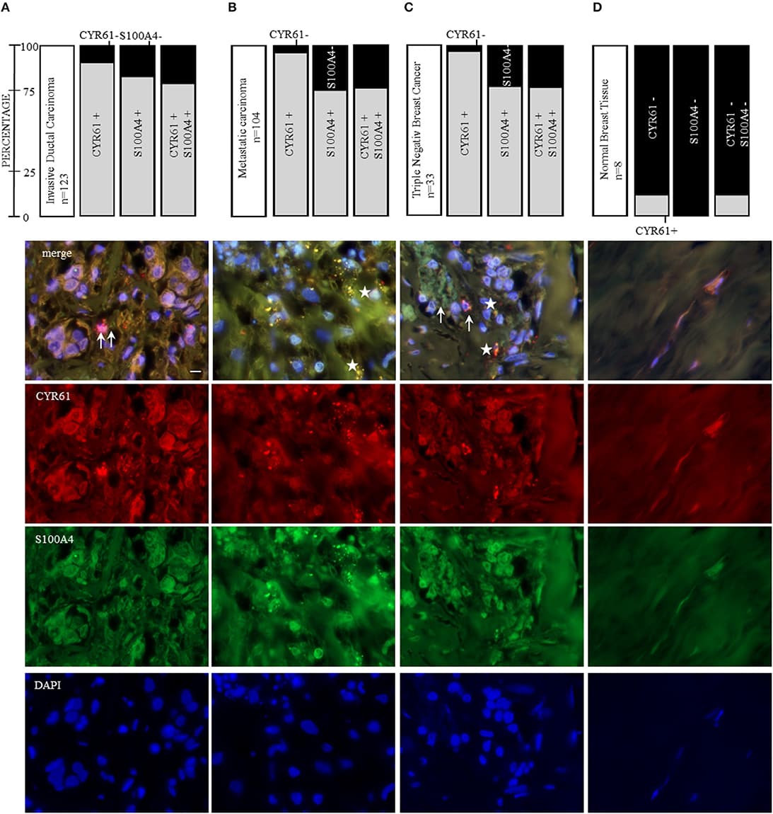 CYR61 and S100A4 as therapeutic target for invasive and metastatic breast cancer. Immunofluorescence staining of three tissue arrays (biomax) containing 104 invasive ductal carcinoma tissue sections with corresponding metastatic carcinomas, further 21 invasive ductal carcinoma tissue sections and 8 normal breast tissue sections. With 33 of the carcinoma tissue sections being negative for the estrogen receptor and progesterone receptor and do not overexpress the Her2neu receptor (triple negative breast cancer, TNBC). (A) CYR61 and/or S100A4 expression analysis in 123 invasive ductal carcinoma tissue sections and corresponding lymph node sections from 104 patients (B) and representative immunofluorescence staining analyzed with a 100x oil objective (Axio ZEISS). (C) Within the 123 invasive ductal carcinomas patient tissue sections 33 were stated as being TNBC. (D) Normal breast tissue sections (n = 8) were analyzed for their CYR61 and/ or S100A4 expression using immunofluorescence staining. Scale bar gauges 20 μm.