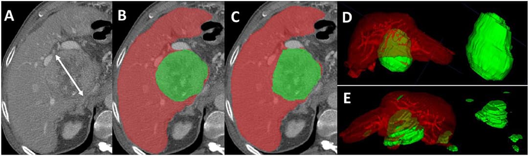 Axial sections from a pre-TACE abdominal CT scan of a 64-year old male patient with advanced HCC. (A) Shows an 8.5 cm lesion measured with mRECIST criteria. (B) Shows the manual segmentation of the hepatic parenchyma (red) and the HCC tissue (green); the tumor volume, measured with M-vRECIST, was 377.25 cm3. (C) Shows the automated segmentation of the parenchyma (red) and HCC tissue (green); the tumor volume measured with A-vRECIST was 187.9 cm3. (D,E) Show the 3-dimensional voxel rendering according to M-vRECIST and A-vRECIST, respectively. A-vRECIST, automated volumetric response evaluation criteria in solid tumors; CT, computed tomography; HCC, hepatocellular carcinoma; mRECIST, modified response evaluation criteria in solid tumors; M-vRECIST, manual volumetric response evaluation criteria in solid tumors; RECIST, response evaluation criteria in solid tumors; TACE, transarterial chemo embolization.