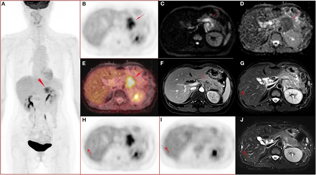 A 51-year-old female with pancreatic ductal adenocarcinoma in body and tail with hepatic metastases. (A–J) Whole body PET image with maximum intensity projection (MIP) (A) and axial abdominal PET image (B) showed FDG metabolism increased lesion in pancreatic body and tail, with SUVmax 7.52, SUVpeak 6.39, and MTV 17.43 cm3. Diffusion weighted imaging (DWI, b = 800) (C) and apparent diffusion coefficient (ADC) map (D) showed a diffusion restricted lesion in pancreatic body and tail. (E) Fused image of PET and ADC showed a diffusion restricted lesion with hyper FDG metabolism. (F) Contrast enhanced (CE) T1 weighted image (T1WI) with fat suppression (fs) on late arterial phase showed hypo-vascular lesion and dilated main pancreatic duct, and the maximum diameter of the lesion was 4.7 cm. (G,H) Metastasis in the right lobe of the liver (arrow) confirmed by surgery operation (2 days after the initial PET/MR examination) and histo-pathological examination, and the lesion showed slightly hyper-intensity on T2 weighted image with fat saturation (G), no FDG avid lesion on PET image (H). (I–J) Follow up PET/MR 112 days after operation showed the operated region with hyper-intensity in T2 weighted image with fat saturation (J) and without abnormal FDG uptake on PET image (I).
