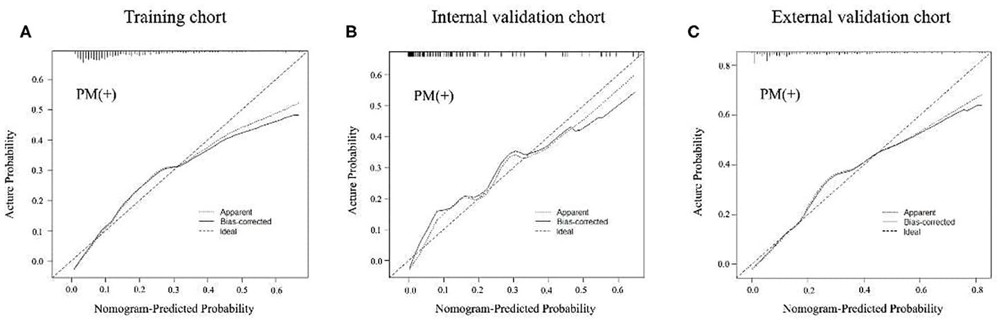 Calibration curves of radiomics nomogram of peritoneal metastasis (PM) status prediction in training and internal and external validation cohorts. The calibration curves described the calibration in agreement between predicted and observed outcome. The 45-degree reference line means a perfect calibration with the outcome by ideal model. The solid line is the performance of the nomogram, without correction for overfit. The dotted line is the bootstrap-corrected performance of the nomogram, with a scatter estimate for future accuracy. (A–C) Calibration curves in the training cohort, internal and external validation cohorts.