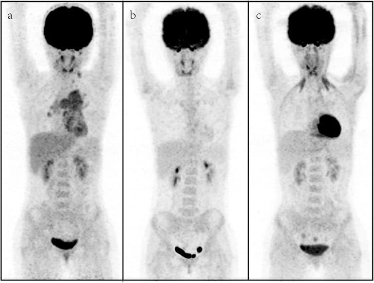 A representative case of an 11-year-old female with rhabdomyosarcoma. Baseline maximum intensity projection (MIP, a), showing hypermetabolic disease in laterocervical, mediastinal, and hilar lymph nodes, liver, and sternum [maximum standardized uptake volume (SUVmax): 4.9, SUVmean: 3.4, SUVpeak: 4.1, metabolic tumor volume (MTV): 77.2 cm3, total lesion glycolysis (TLG): 229.4]. PET/CT (b) after therapy showing a complete metabolic response with no fluoro-deoxyglucose (FDG) uptake in the previous sites. PET/CT (c) for follow-up revealed no FDG uptake lesions.