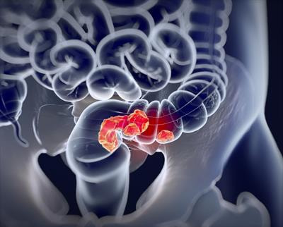 Cover image for research topic "Locally Advanced Rectal Cancer"