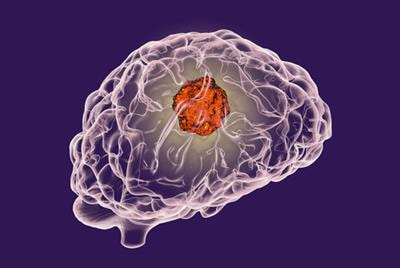 Cover image for research topic "Molecular Advances in Diagnosis and Treatment of CNS Tumors"