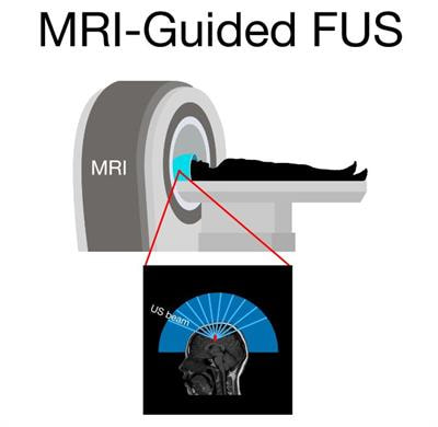 Cover image for research topic "Magnetic Resonance Guided Focused Ultrasound: Physical Principles and Biomedical Applications"