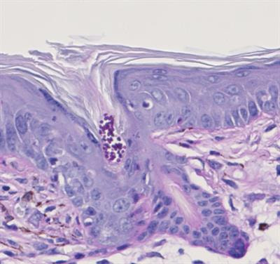 Cover image for research topic "Malassezia: A Skin Commensal Yeast Impacting Both Health And Disease"