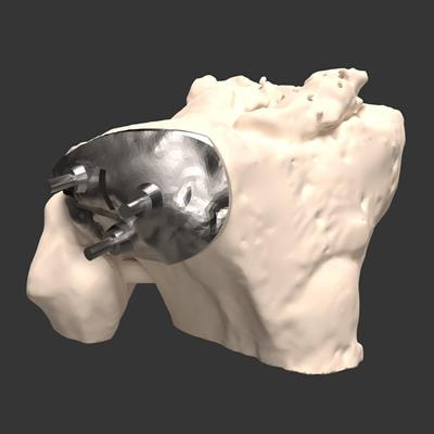 Cover image for research topic "Medical Imaging for Design and Biomechanical Optimisation of Personalised Medical Devices"