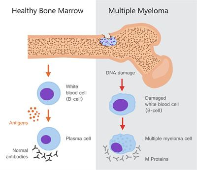 Cover image for research topic "Exploiting the Immune System to Treat Multiple Myeloma: from Transplantation to Novel Treatment Approaches"