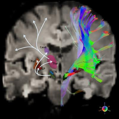 Cover image for research topic "Neuroimaging in Parkinson’s Disease and Parkinsonism"