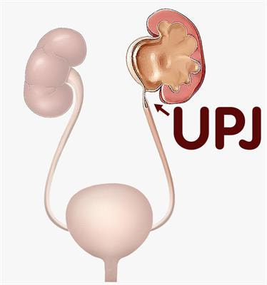 Cover image for research topic "Hydronephrosis Associated with Ureteropelvic Junction Anomalies: An Ongoing Challenge "