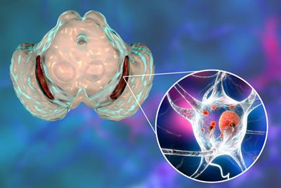 Cover image for research topic "Prodromal Parkinson's Disease"
