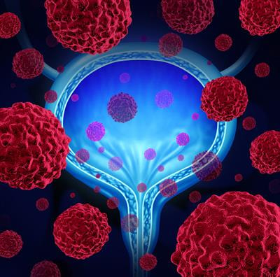 Cover image for research topic "Recent Advances in Diagnosis and Management of Urothelial Carcinoma"