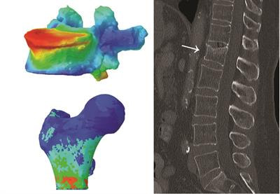 Cover image for research topic "Novel Imaging Biomarkers for Assessment of Bone Health and
Fracture Risk"