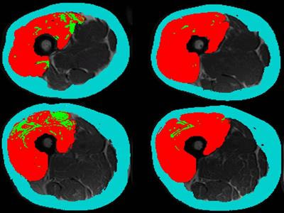 Cover image for research topic "Understanding Sarcopenic Obesity: From Definition to Health Consequences and Management"