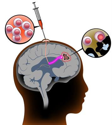 Cover image for research topic "T Cell Therapy for CNS Tumors"