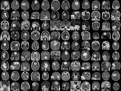 Cover image for research topic "Meningioma: From Basic Research to Clinical Translational Study"
