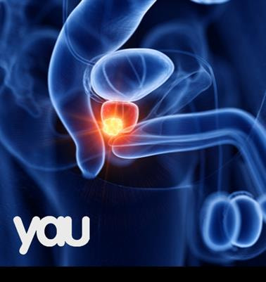Cover image for research topic "Sequelae of Prostate Cancer Therapy: Avoidance strategies and management options"