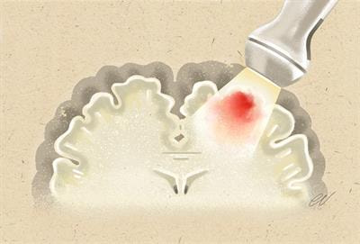 Cover image for research topic "Intraoperative Ultrasound in Brain Tumor Surgery: State-Of-The-Art and Future Perspectives"