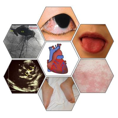 Cover image for research topic "Pathogenesis, Clinical Findings and Treatment Advances in Kawasaki Disease"