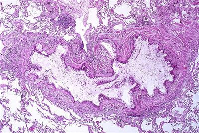 Cover image for research topic "Novel mechanisms and innovative therapies in severe asthma"
