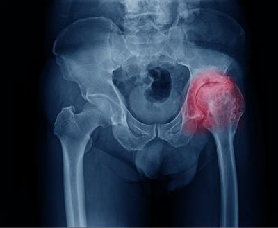 Cover image for research topic "Neuromechanics of Hip Osteoarthritis"