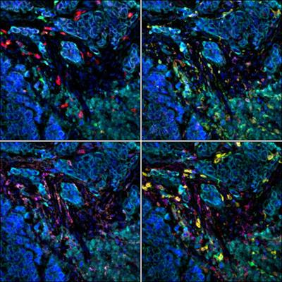 Cover image for research topic "Multiplex Immunohistochemistry/Immunofluorescence Technique: The Potential and Promise for Clinical Application"