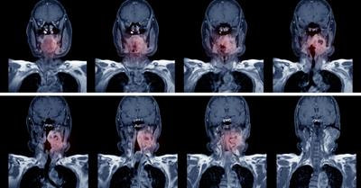 Cover image for research topic "Evaluation, Prediction and Sparing of Radiation-Induced Normal Tissue Damage in Head and Neck Cancer"