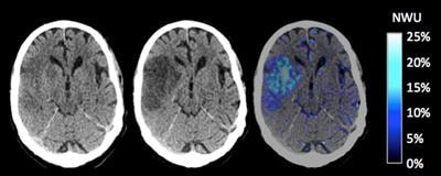 Cover image for research topic "Mechanisms, Measurement, and Management of Vasogenic Edema after Stroke"