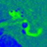 Cover image for research topic "Hydropic Ear Disease: Imaging and functional evaluation"