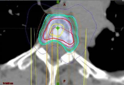 Cover image for research topic "Novel Applications of Stereotactic Body Radiation Therapy (SBRT)"