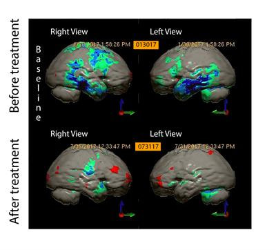 Cover image for research topic "The Emerging Role of SPECT Functional Neuroimaging in Psychiatry & Neurology"