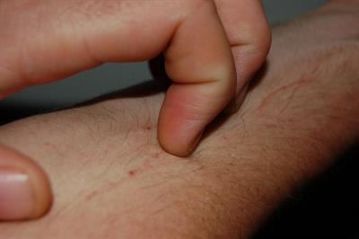 Cover image for research topic "Itch and Allergy"
