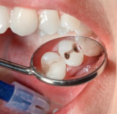 Cover image for research topic "Minimally Invasive Dentistry for Caries Management"