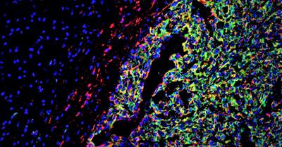Cover image for research topic "The Role of the Immune Response in Brain Metastasis"