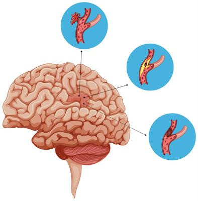 Cover image for research topic "Blood-Based Biomarkers in Acute Ischemic Stroke and Hemorrhagic Stroke"