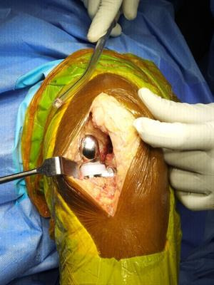 Cover image for research topic "Knee Arthroplasty: Techniques and complications"
