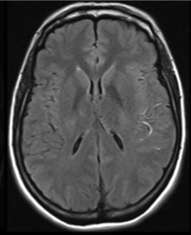 Cover image for research topic "Challenges in Acute Minor Ischemic Stroke"