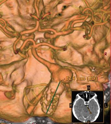 Cover image for research topic "Pathophysiology and Treatment of Fusiform intracranial Aneurysms"
