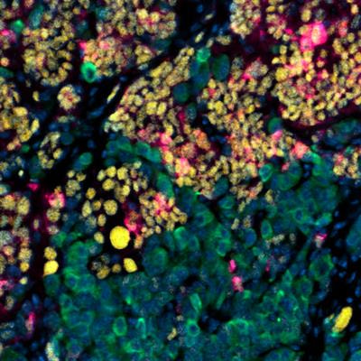 Cover image for research topic "Cellular Plasticity during Cancer Progression"