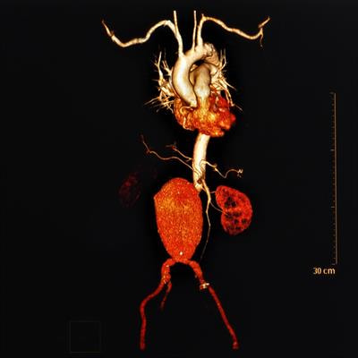 Cover image for research topic "Bicuspid Aortic Valve: From pathophysiological mechanisms, imaging diagnosis to clinical treatment methods"
